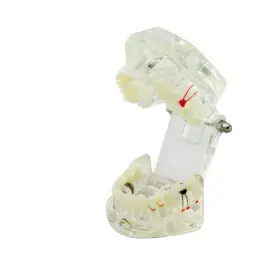 380051 Denshine Dental Disease Fixed Teeth Model With Restoration Bridge Tooth Usa Fda-ce