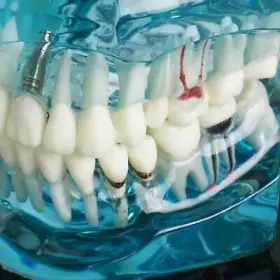380184 Denshine Dental Study Adult Pathological Teeth Model - Transparent #3