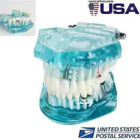 380184 Denshine Dental Study Adult Pathological Teeth Model - Transparent