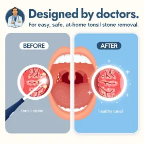 Frederick Medical Supply 313046793707 Dr. S Original Easy Tonsil Stone Remover Kit - Fast Painless Tonsillol #3